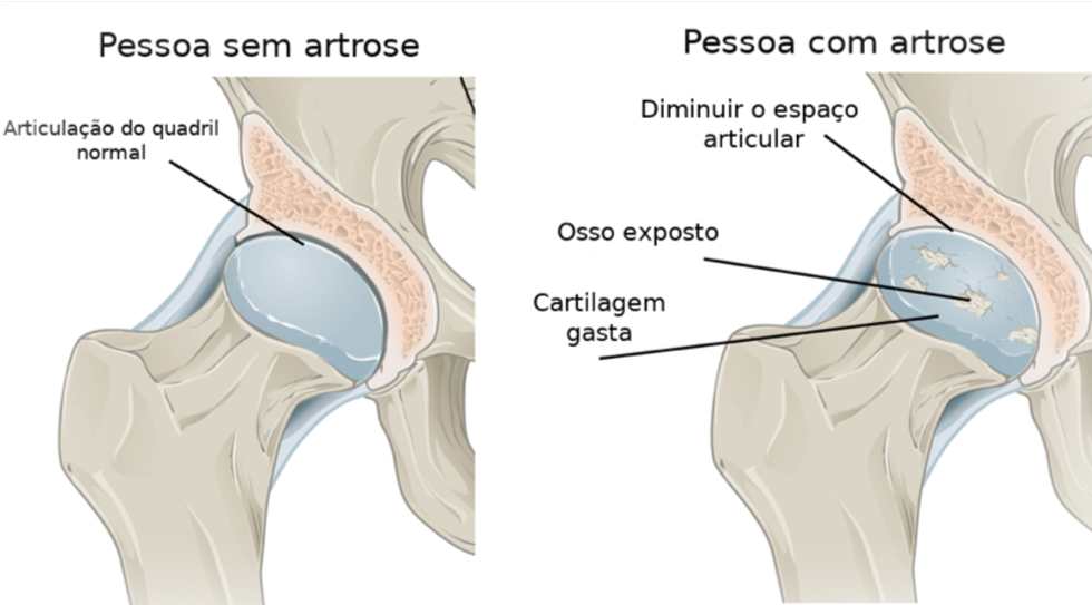 diagrama artrose
