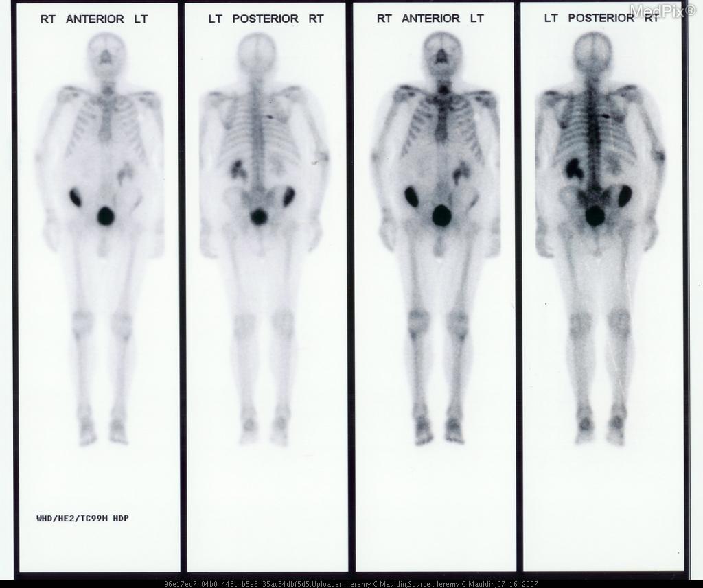 Imagens da evolução do quadro de um paciente de câncer de próstata