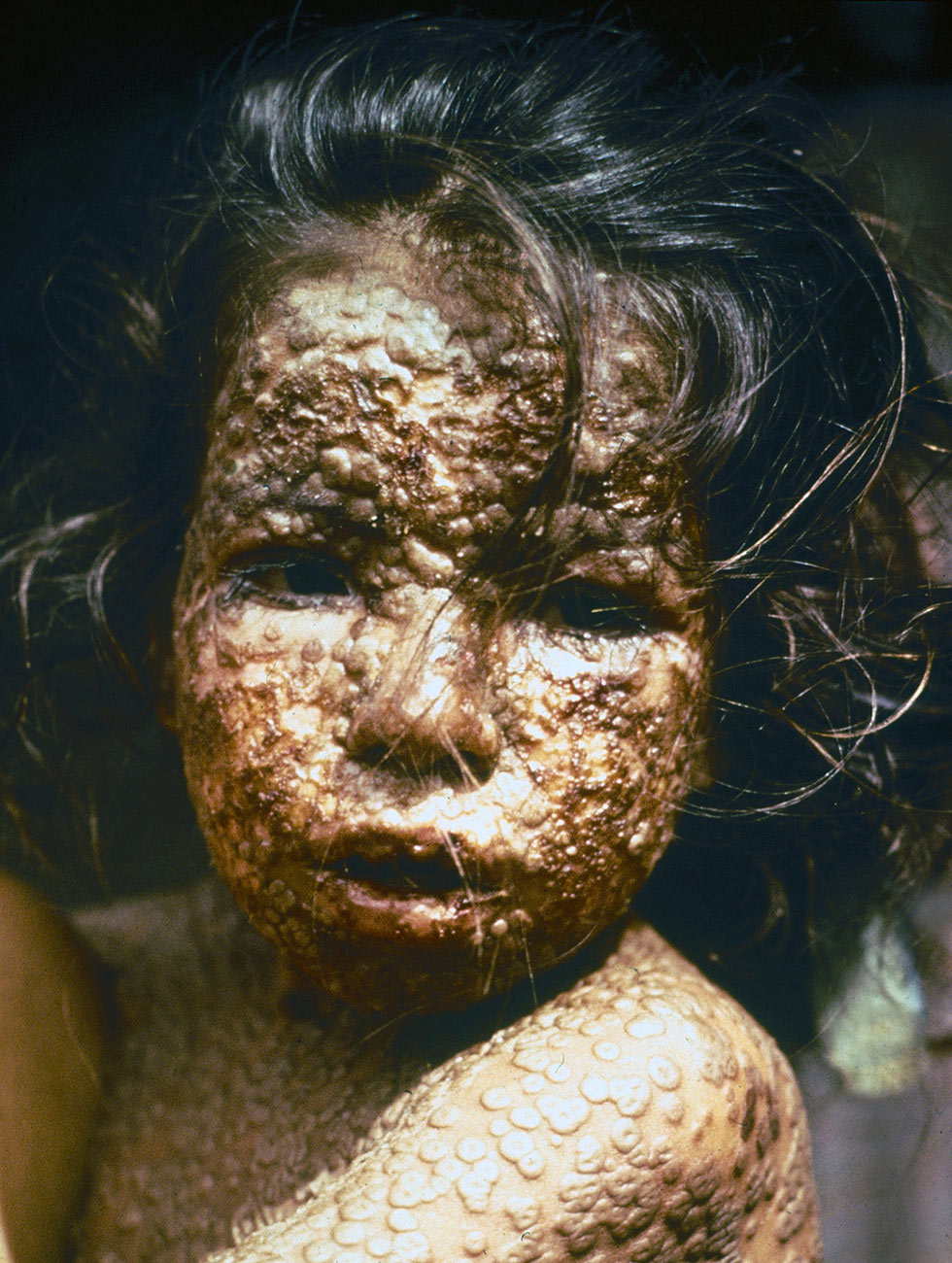 Criança com varíola, na Ásia, em imagem de 1973